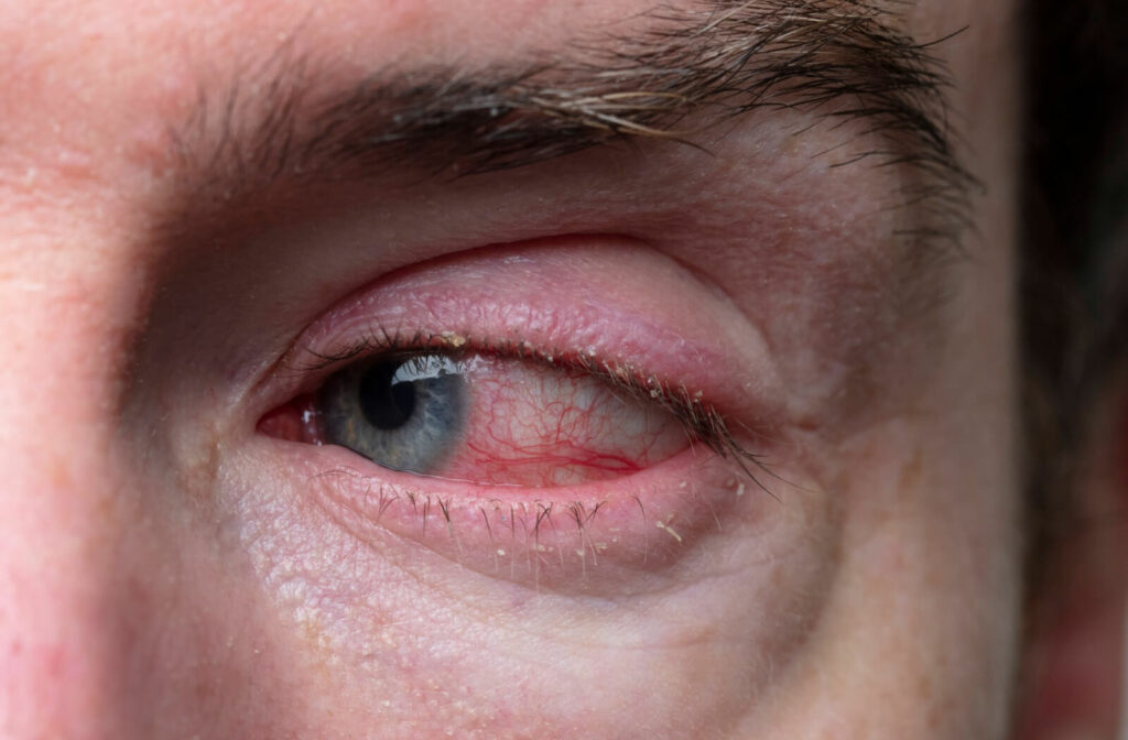 A close-up of a man's eye with infection, an inflammation of the eyelid.