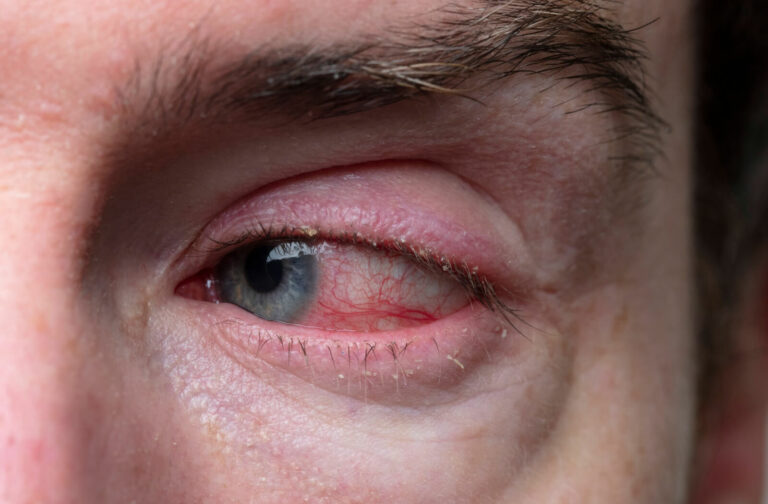 blepharitis-vs-pink-eye-know-the-difference-san-clemente