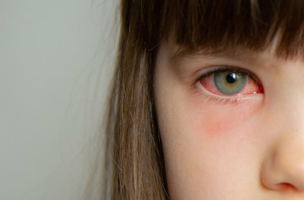 A young kid girl with pink eye.