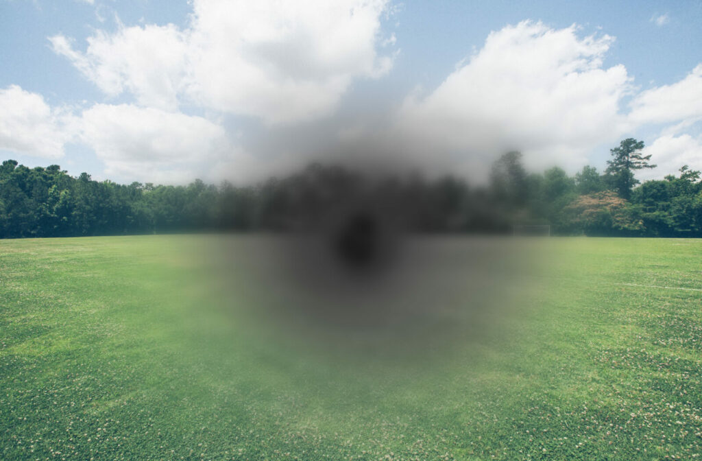 A sample vision of a person with  macular degeneration, which may result in blurred or no vision in the center of the visual field.