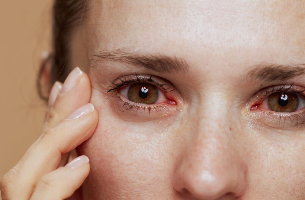 Closeup of a young person with inflamed eyes.